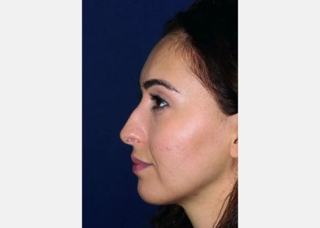 Гнел георгиевич ринопластика