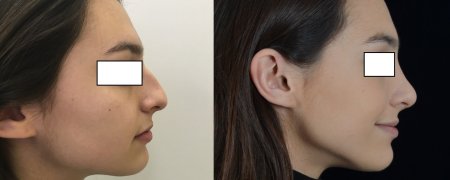 Хайбула камилович ринопластика