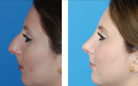 Ринопластика курносого носа