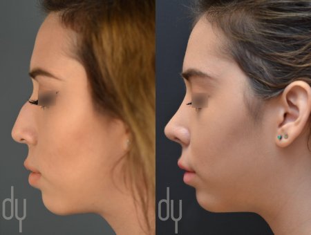 Ринопластика курносого носа