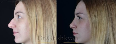 Ринопластика горбинки носа