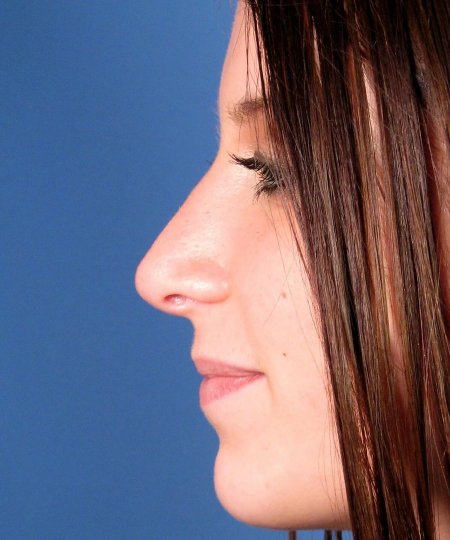 Ринопластика горбинки носа