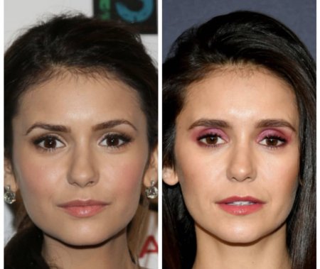 Нина Добрев блефаропластика