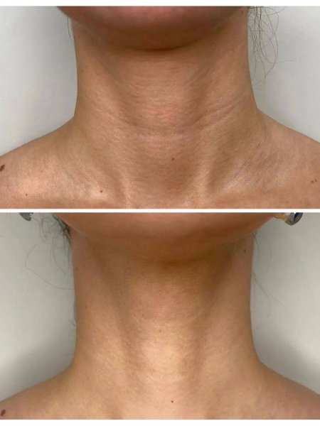 Кольца венеры