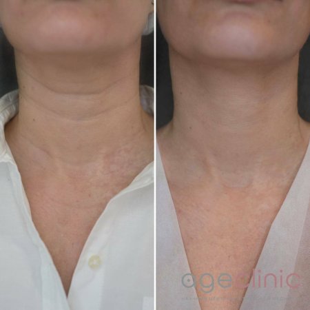 Рф лифтинг результат