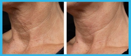 Морщины на шее