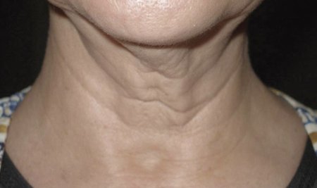 На шее кольца венеры