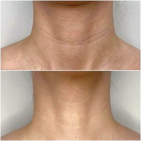 Шея кольца венеры