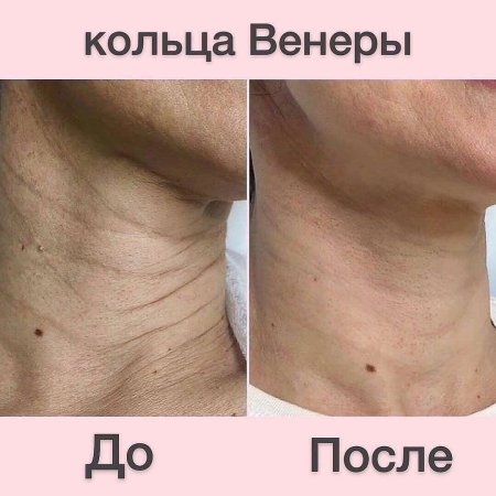 На шее кольца венеры