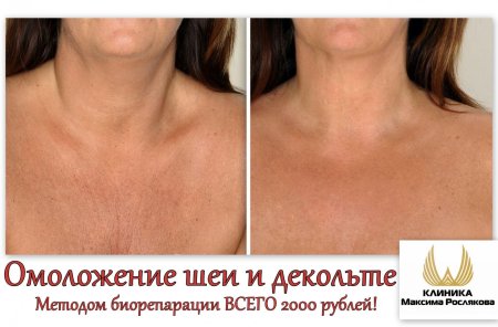 Биоревитализация шеи и декольте