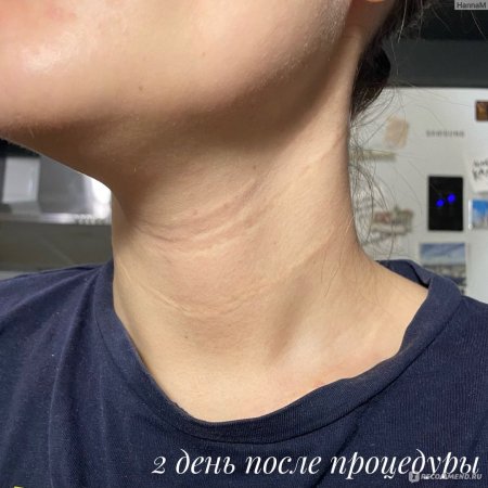 Белотеро софт кольца венеры