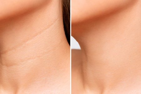 Морщины на шее