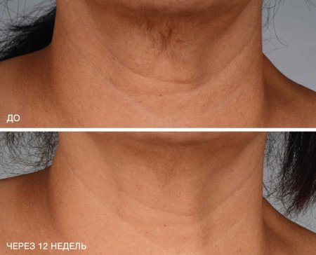 Морщины на шее