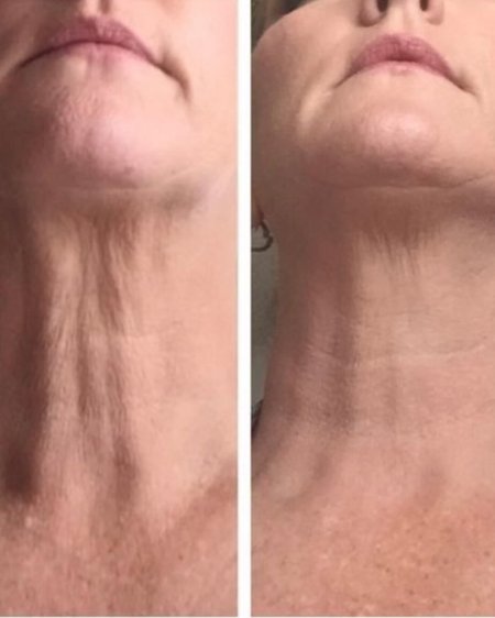 Кольца венеры нитевой лифтинг