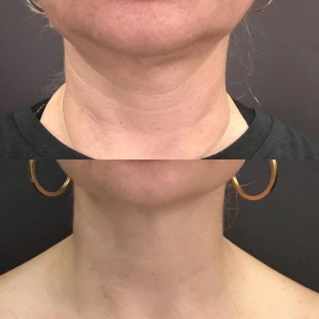 Кольца венеры на шее причины