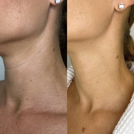 На шее кольца венеры