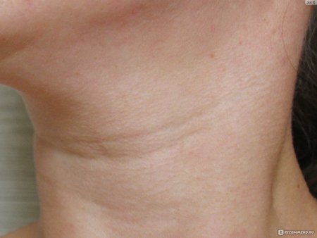 Лейкодерма ожерелье венеры