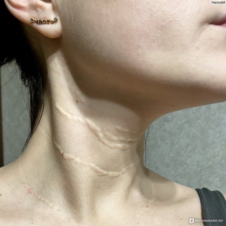 На шее кольца венеры