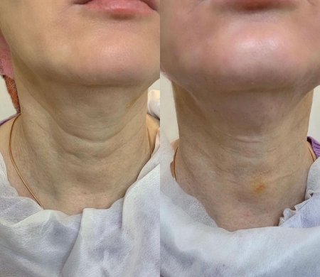 Кольца венеры