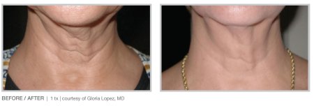 Морщины на шее