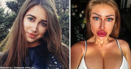 Екатерина Галиченко до и после пластики