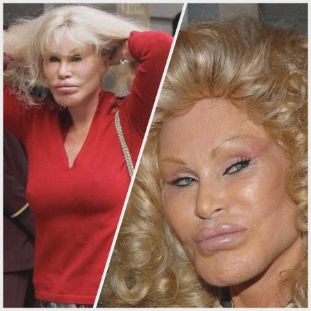 Джослин вильденштейн до операции