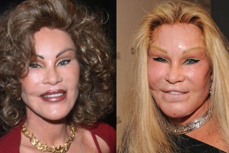 Джослин вильденштейн до операции