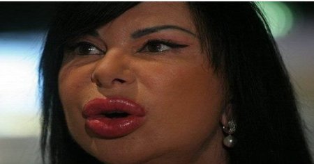 Жертва пластической хирургии Лейла Алиева