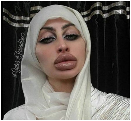 Неудачные пластические операции губ