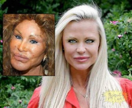 Жертвы пластических операций