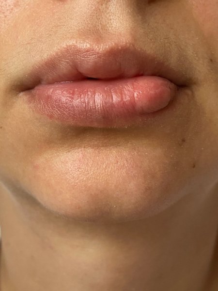 Комки в губах после увеличения