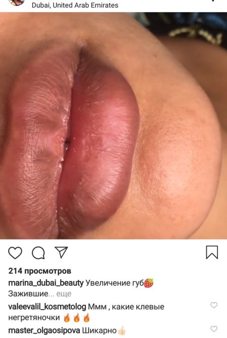 Увеличение губ