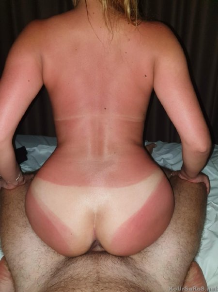 Солнечные ожоги