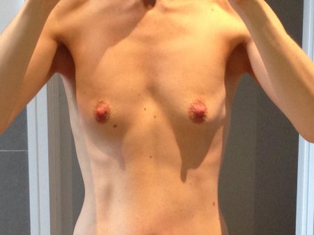 Пластика груди