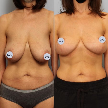 Пластика груди