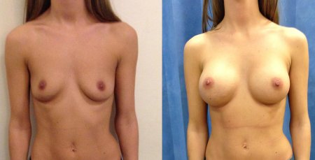 Редукционная маммопластика