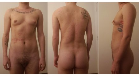 Трансгендеры мастэктомия