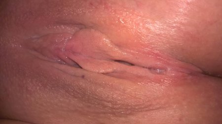 Папиллома влагалища