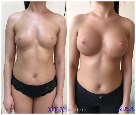 До и после увеличения груди