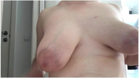 Пластика груди