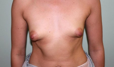 Пубертатная гинекомастия