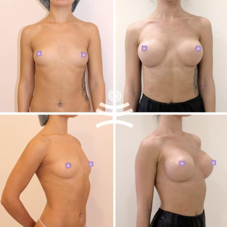 Каплевидная грудь