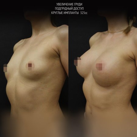 Маммопластика до и после