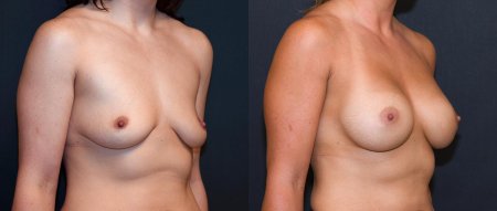 Тубулярная грудь