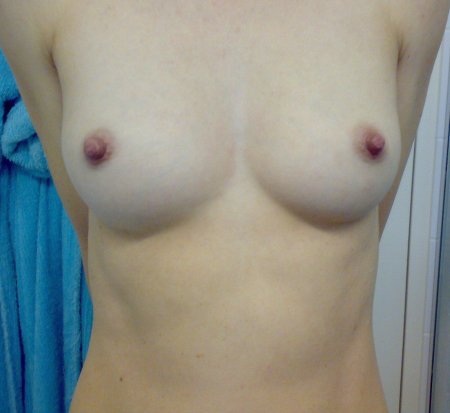 Пластика груди