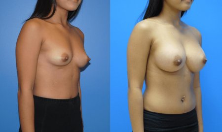 Вытянутая женская грудь