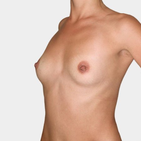 Пластика груди