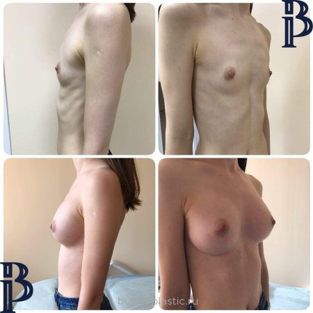 Пластика груди до и посл