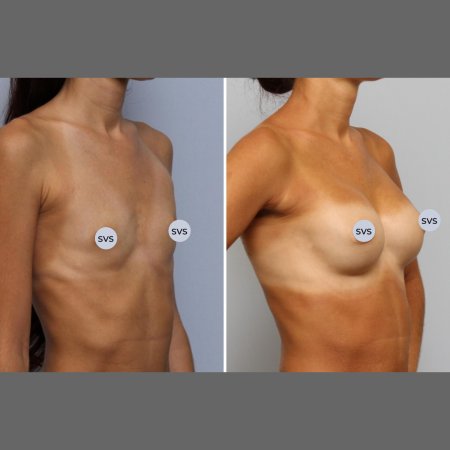 Пластика груди