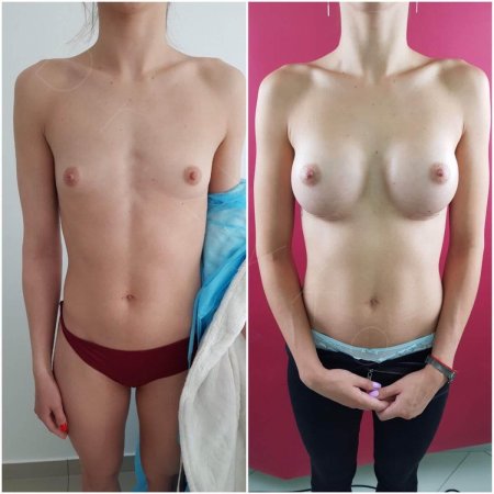 Увеличение груди